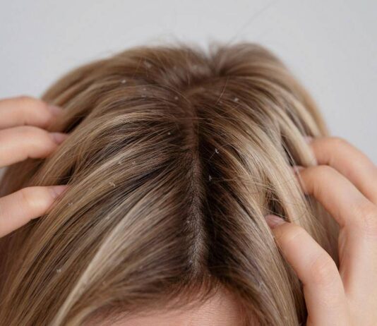 Jak pozbyć się łupieżu?